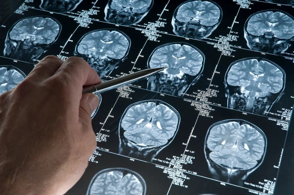 Yeni bilimsel araştırma Alzheimer’a çare olabilir
