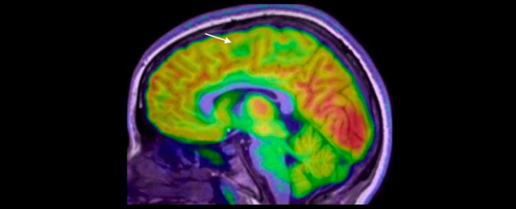 Yeni yapay zeka aracı çocuklarda epilepsiye neden olan gizli beyin lezyonlarını ortaya çıkardı