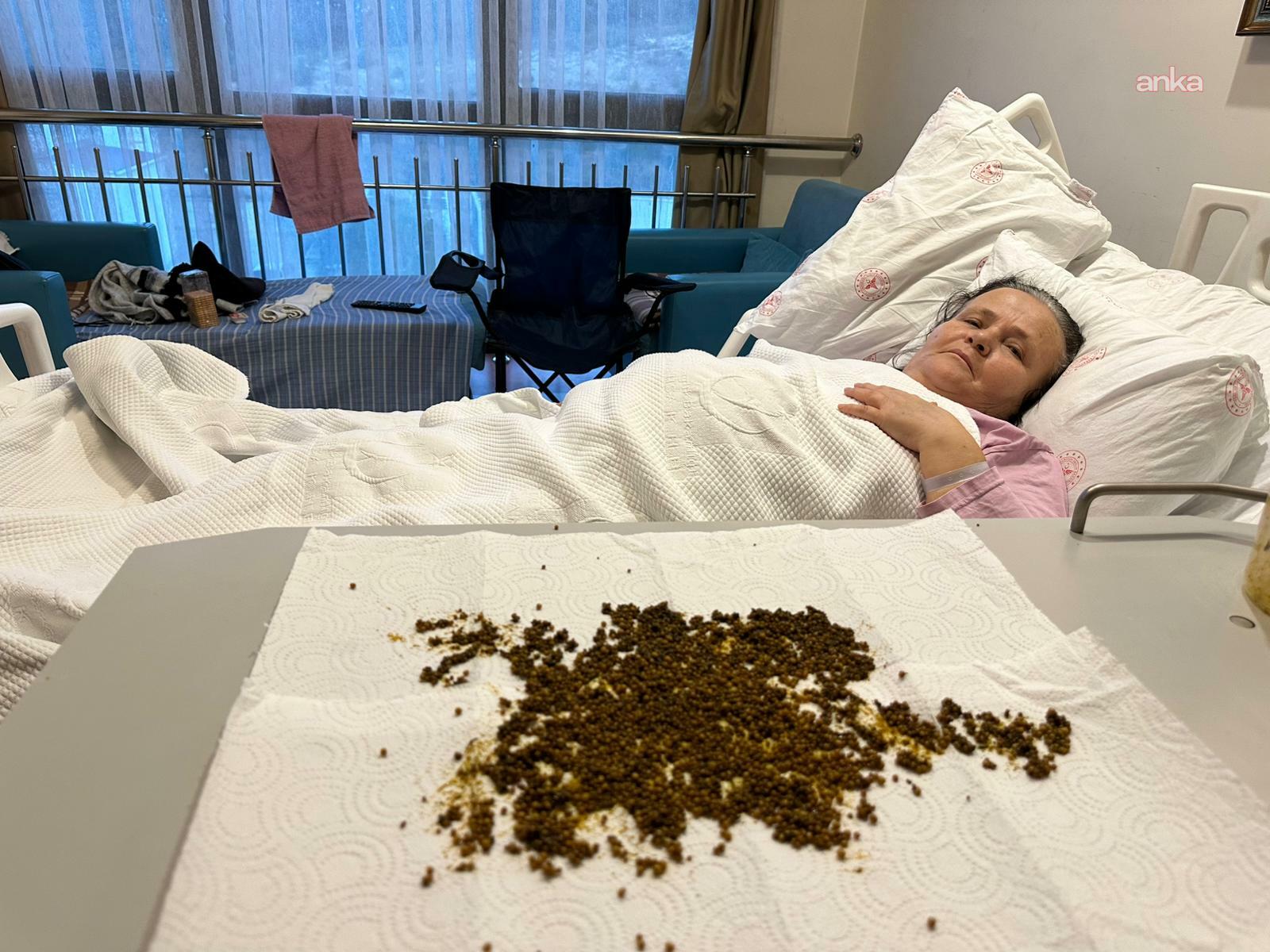 Manisa’da nadir ameliyat: Safra kesesinden 20 binden fazla taş çıkarıldı